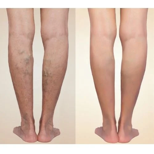 Nutrilegs Forte 3+1 AJÁNDÉK